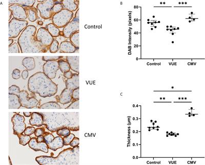 Expression of Immune Checkpoint Receptors in Placentae With Infectious and Non-Infectious Chronic Villitis